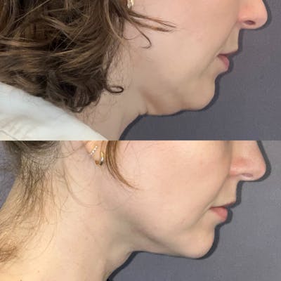 Submental Liposuction Before & After Gallery - Patient 233154 - Image 2