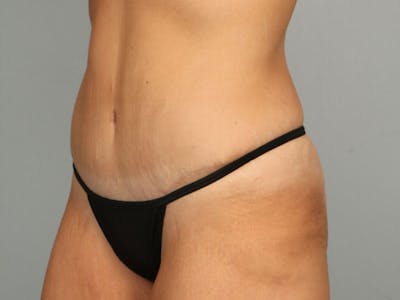 Tummy Tuck (Abdominoplasty) Before & After Gallery - Patient 584697 - Image 4