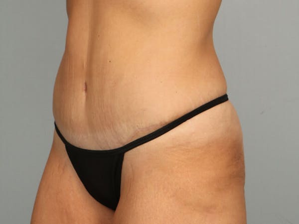 Tummy Tuck (Abdominoplasty) Before & After Gallery - Patient 584697 - Image 4