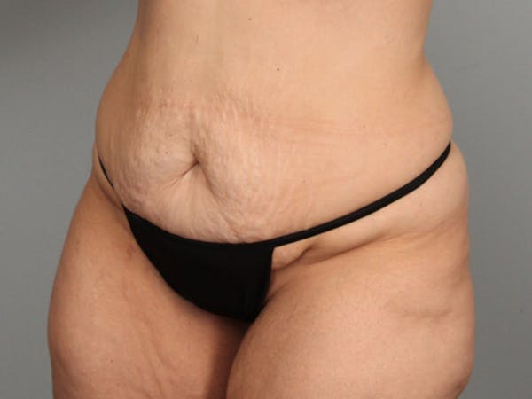 Tummy Tuck (Abdominoplasty) Before & After Gallery - Patient 584697 - Image 3