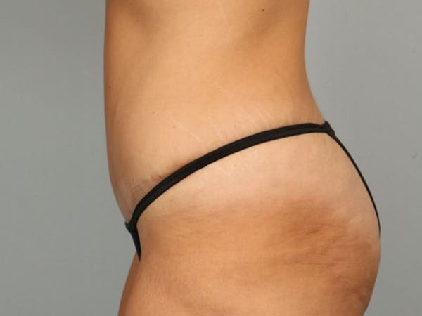 Tummy Tuck (Abdominoplasty) Before & After Gallery - Patient 584697 - Image 6