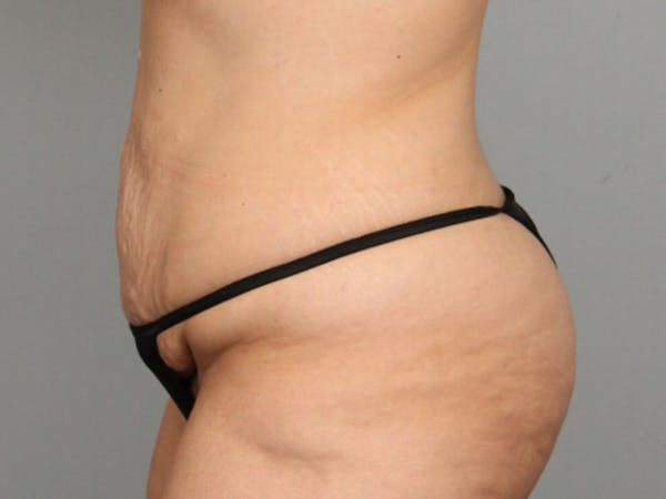 Tummy Tuck (Abdominoplasty) Before & After Gallery - Patient 584697 - Image 5