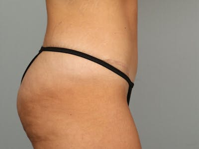 Tummy Tuck (Abdominoplasty) Before & After Gallery - Patient 584697 - Image 8