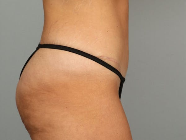 Tummy Tuck (Abdominoplasty) Before & After Gallery - Patient 584697 - Image 8