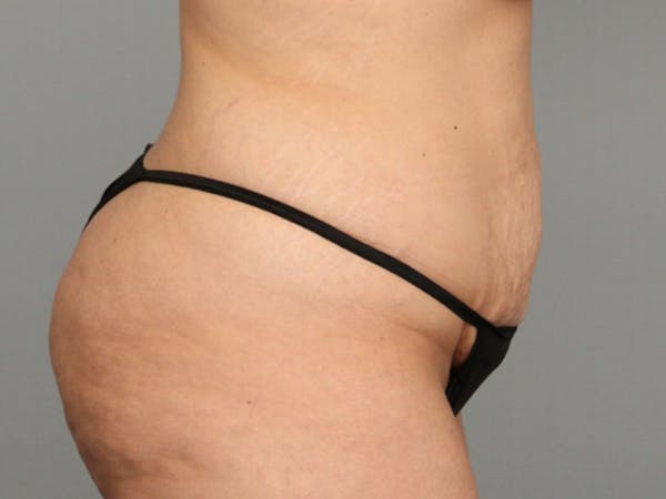 Tummy Tuck (Abdominoplasty) Before & After Gallery - Patient 584697 - Image 7