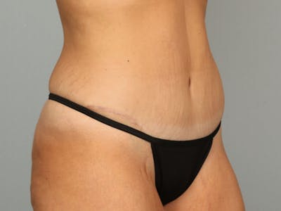 Tummy Tuck (Abdominoplasty) Before & After Gallery - Patient 584697 - Image 10