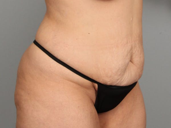 Tummy Tuck (Abdominoplasty) Before & After Gallery - Patient 584697 - Image 9