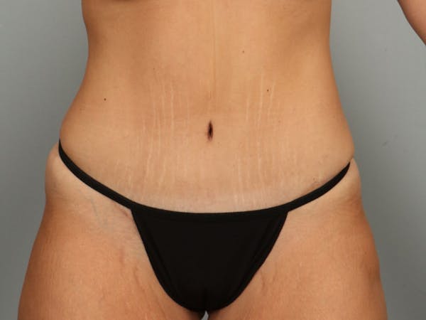 Tummy Tuck (Abdominoplasty) Before & After Gallery - Patient 584697 - Image 2