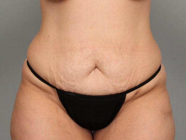 Tummy Tuck (Abdominoplasty) Before & After Gallery - Patient 584697 - Image 1