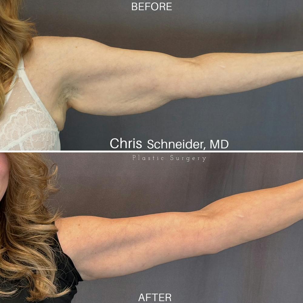Arm Lift Before & After Gallery - Patient 369960 - Image 3