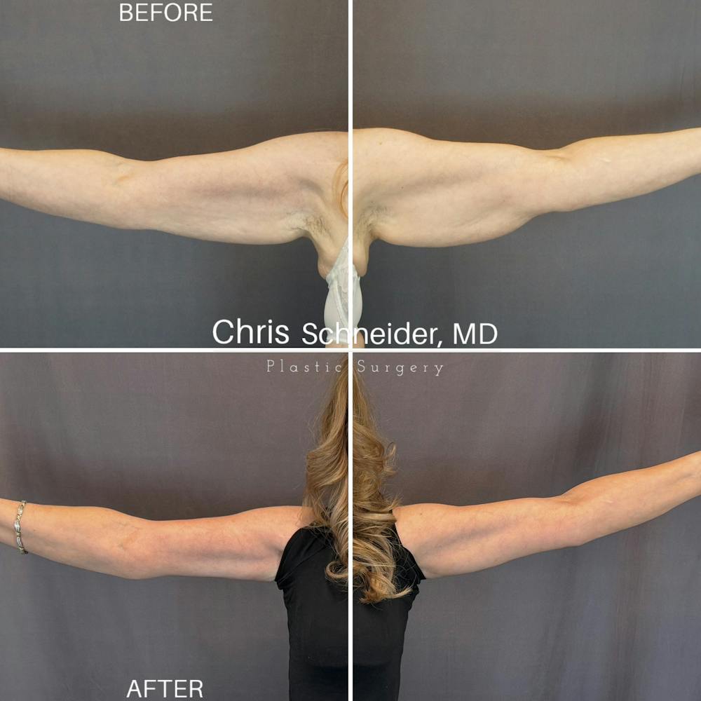 Arm Lift Before & After Gallery - Patient 369960 - Image 1