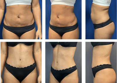 Tummy Tuck (Abdominoplasty) Before & After Gallery - Patient 257799 - Image 1