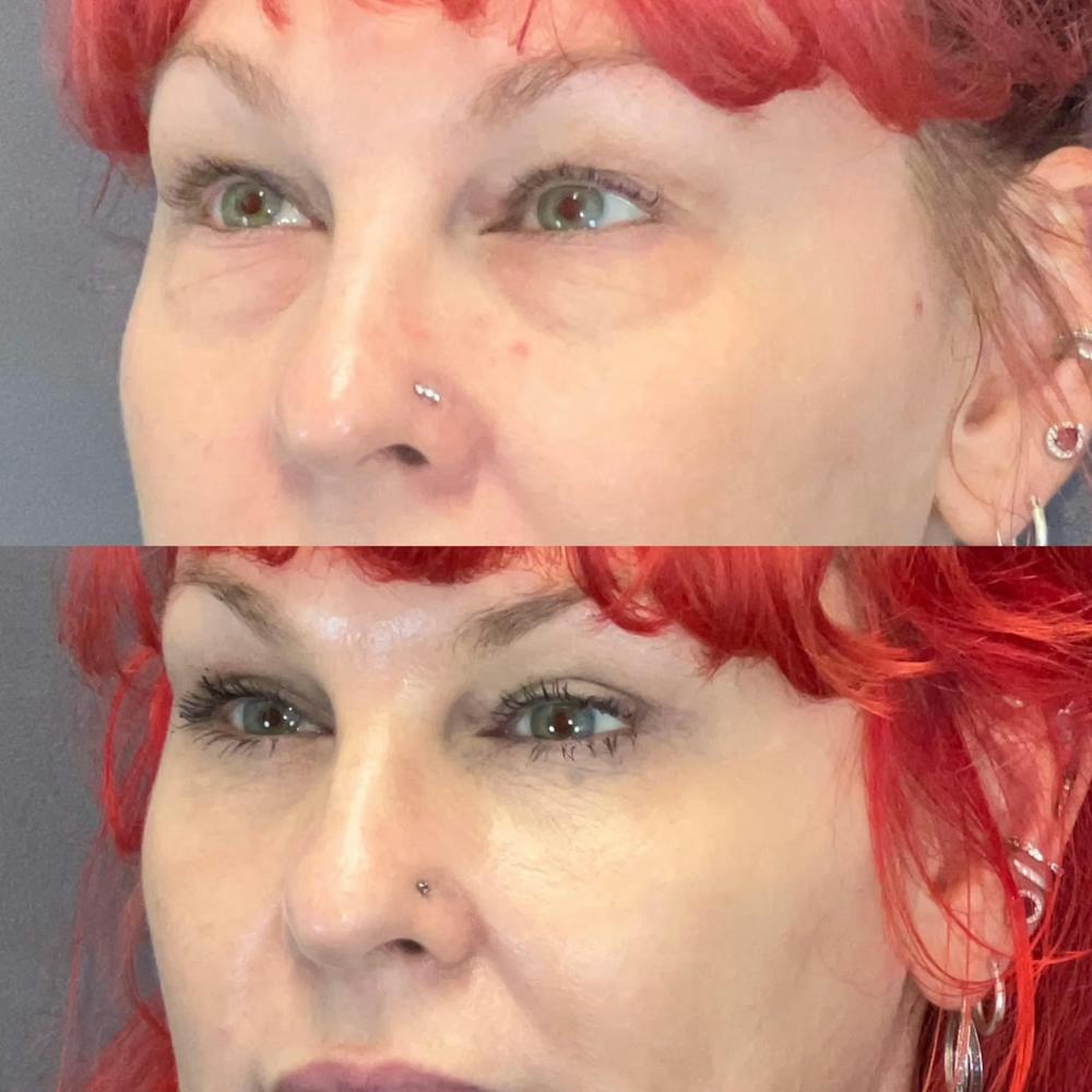 Upper Blepharoplasty Before & After Gallery - Patient 222246 - Image 1