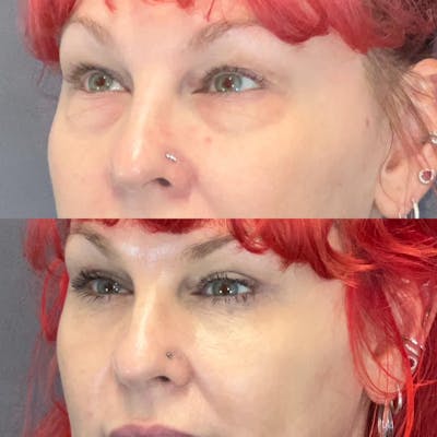 Upper Blepharoplasty Before & After Gallery - Patient 222246 - Image 1