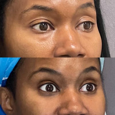 Lower Blepharoplasty Before & After Gallery - Patient 389367 - Image 1