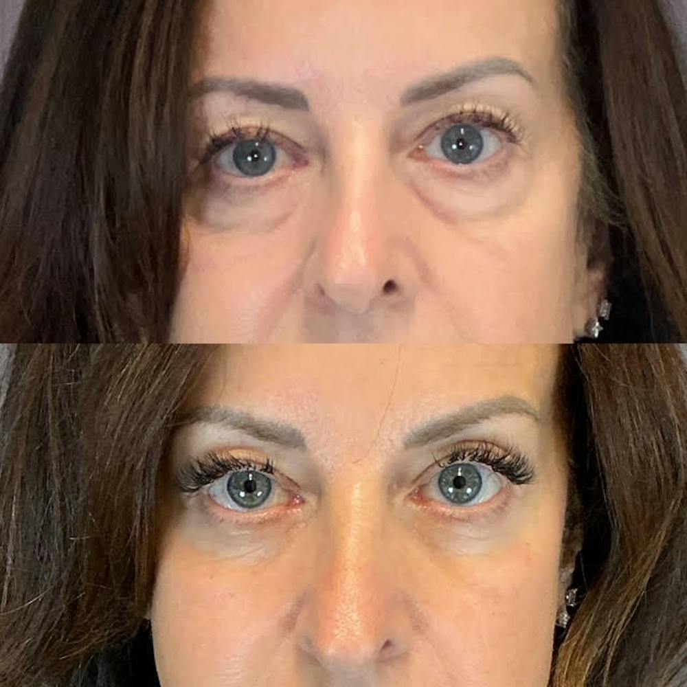 Lower Blepharoplasty Before & After Gallery - Patient 214214 - Image 1