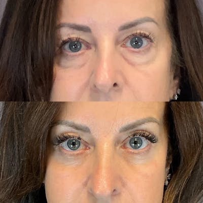 Lower Blepharoplasty Before & After Gallery - Patient 214214 - Image 1
