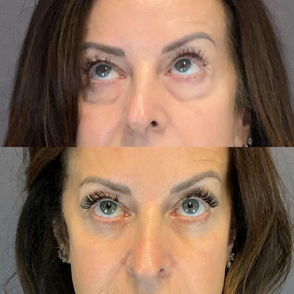 Lower Blepharoplasty Before & After Gallery - Patient 214214 - Image 2