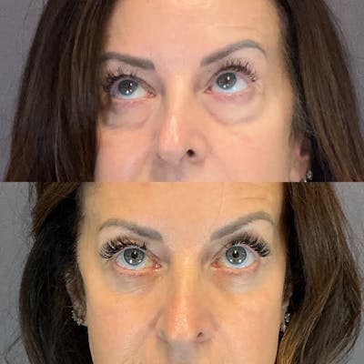 Lower Blepharoplasty Before & After Gallery - Patient 214214 - Image 2