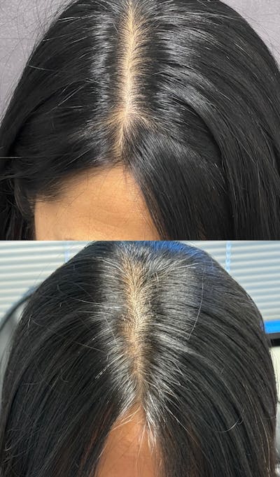 Hair Restoration  Before & After Gallery - Patient 251312 - Image 1