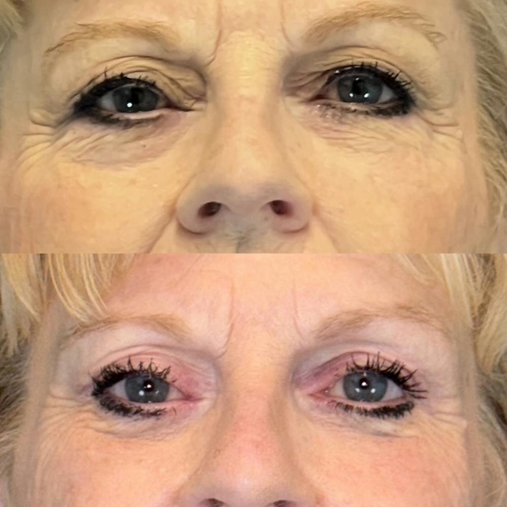 Lower Blepharoplasty Before & After Gallery - Patient 139010 - Image 1