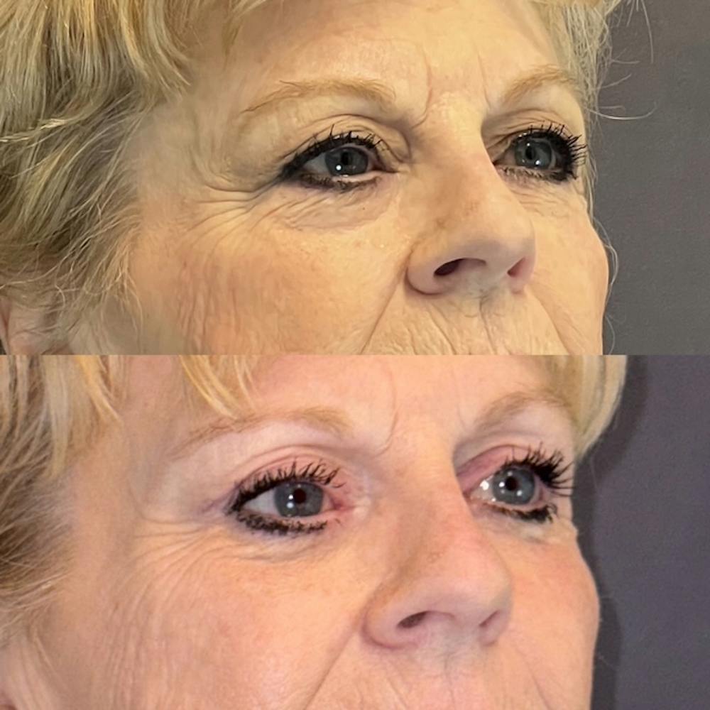 Lower Blepharoplasty Before & After Gallery - Patient 139010 - Image 2
