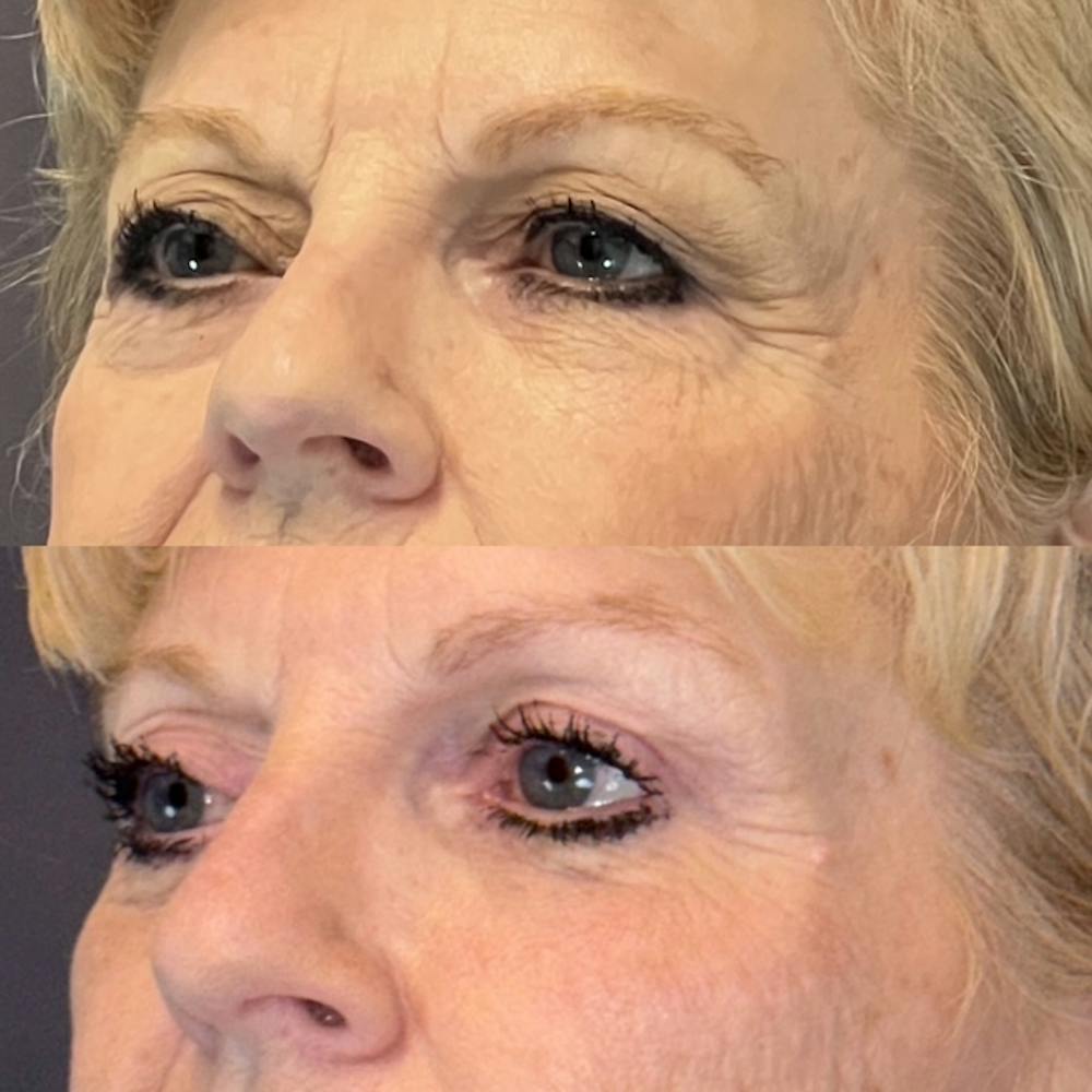Lower Blepharoplasty Before & After Gallery - Patient 139010 - Image 3