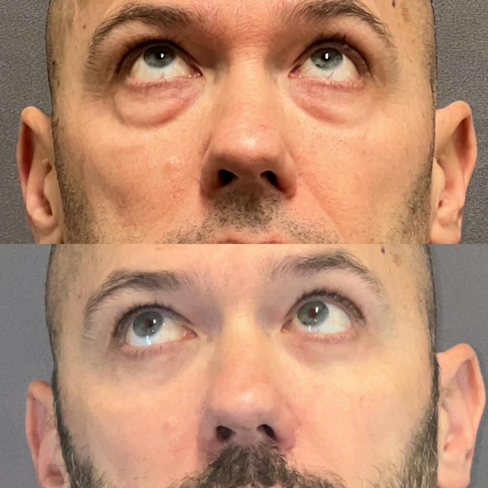 Lower Blepharoplasty Before & After Gallery - Patient 108930 - Image 2
