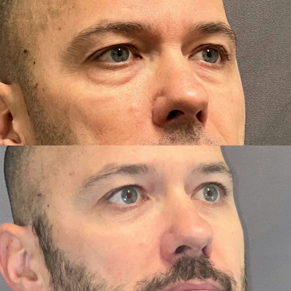Lower Blepharoplasty Before & After Gallery - Patient 108930 - Image 3