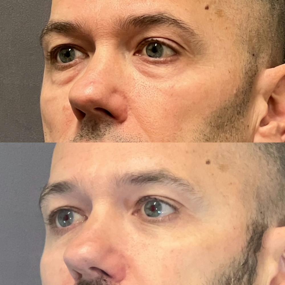 Lower Blepharoplasty Before & After Gallery - Patient 108930 - Image 4