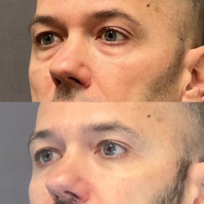 Lower Blepharoplasty Before & After Gallery - Patient 108930 - Image 4