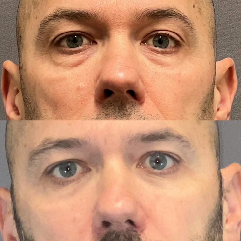Lower Blepharoplasty Before & After Gallery - Patient 108930 - Image 1