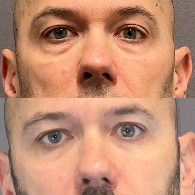 Lower Blepharoplasty Before & After Gallery - Patient 108930 - Image 1