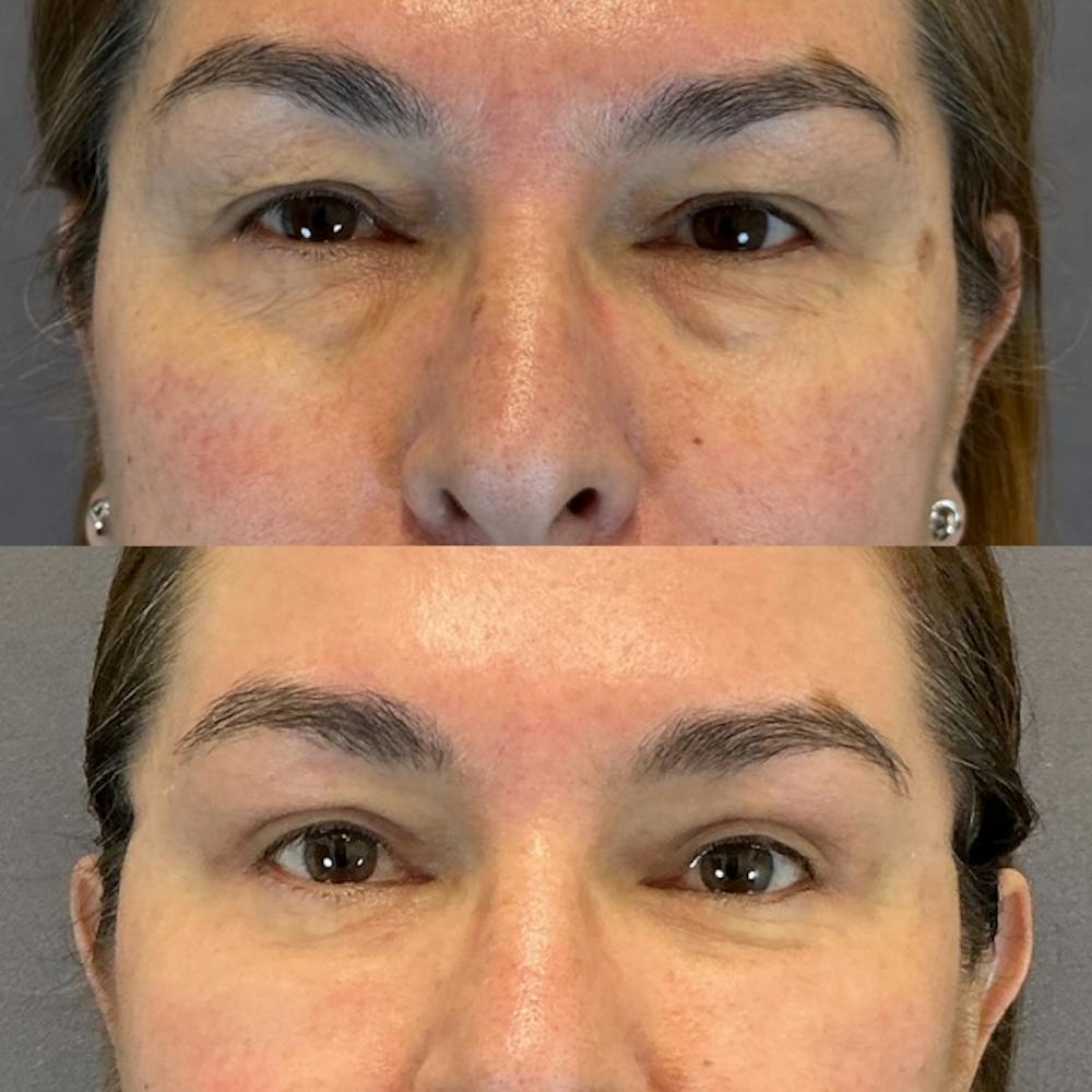Lower Blepharoplasty Before & After Gallery - Patient 123820 - Image 1