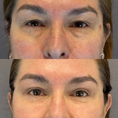 Lower Blepharoplasty Before & After Gallery - Patient 123820 - Image 1