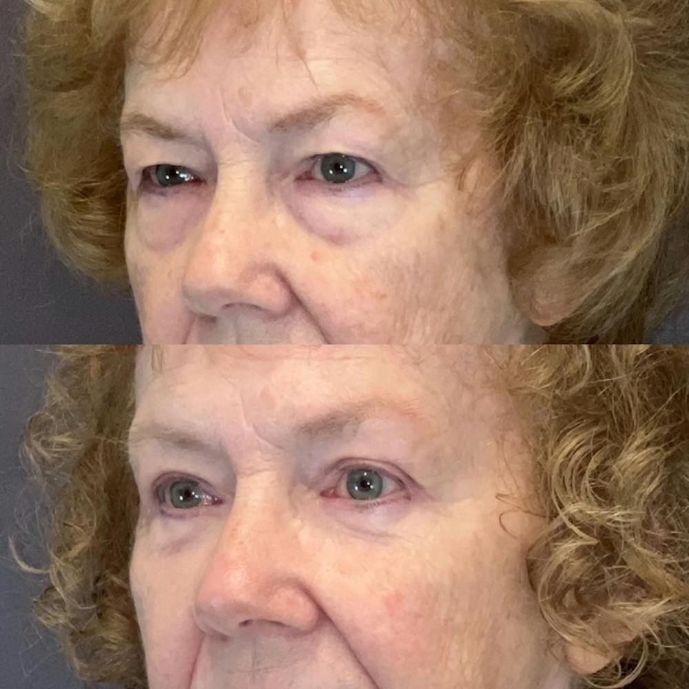 Lower Blepharoplasty Before & After Gallery - Patient 193795 - Image 3