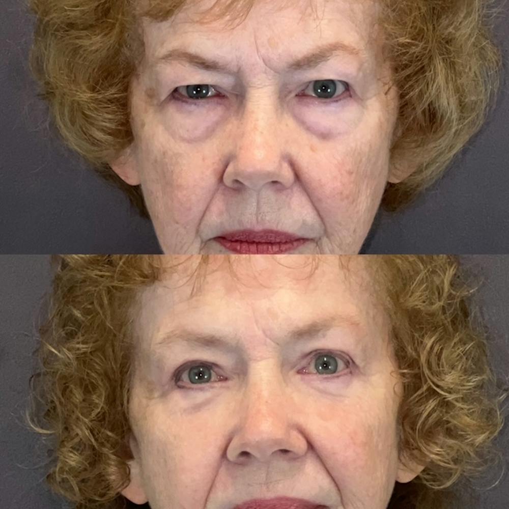 Lower Blepharoplasty Before & After Gallery - Patient 193795 - Image 1