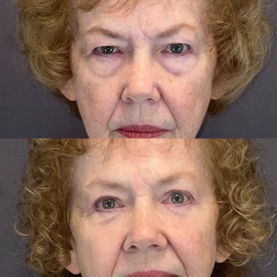 Lower Blepharoplasty Before & After Gallery - Patient 193795 - Image 1