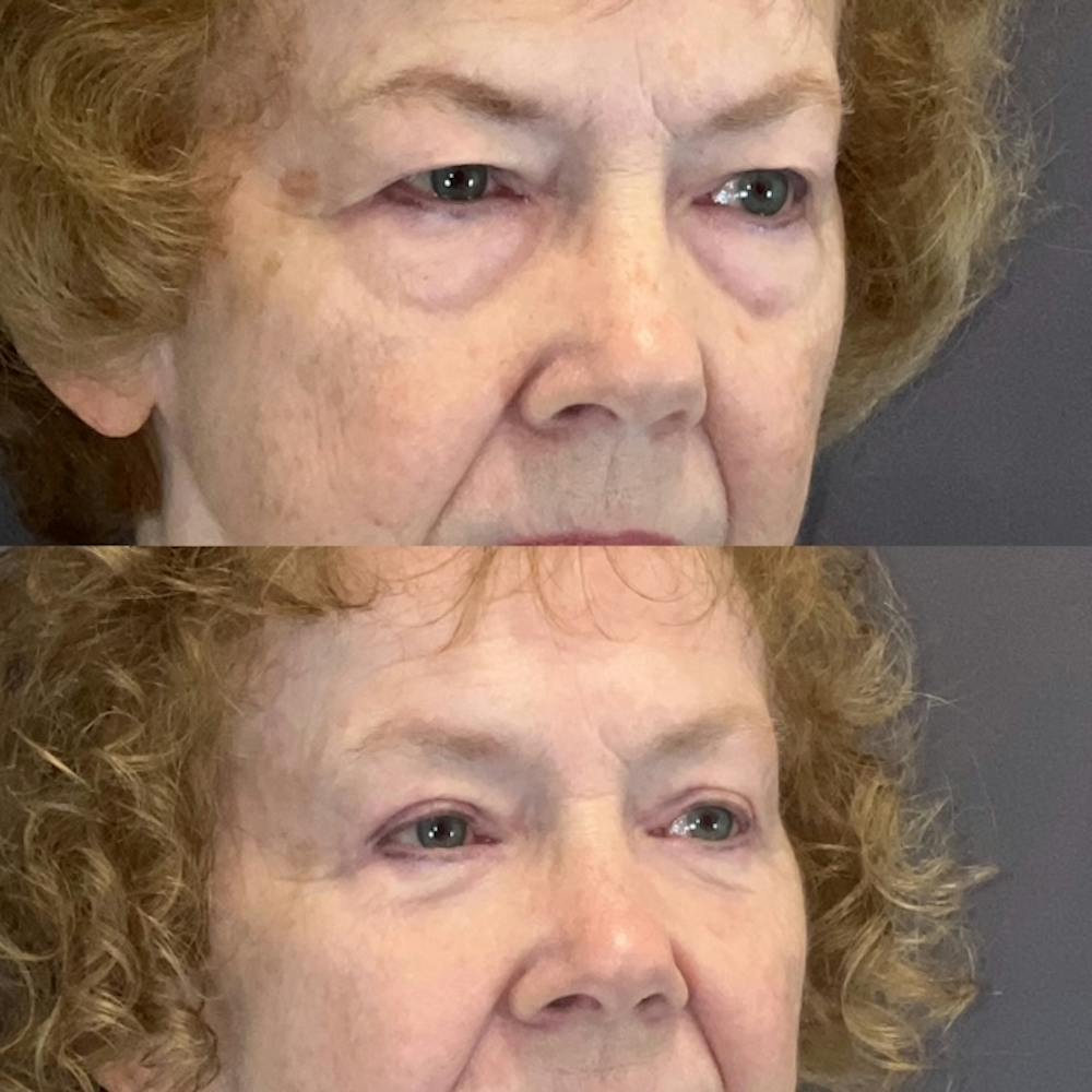 Lower Blepharoplasty Before & After Gallery - Patient 193795 - Image 2