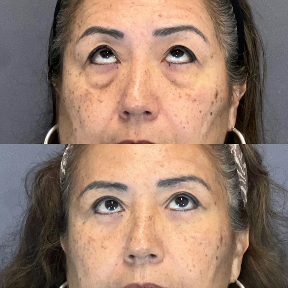 Lower Blepharoplasty Before & After Gallery - Patient 835184 - Image 2