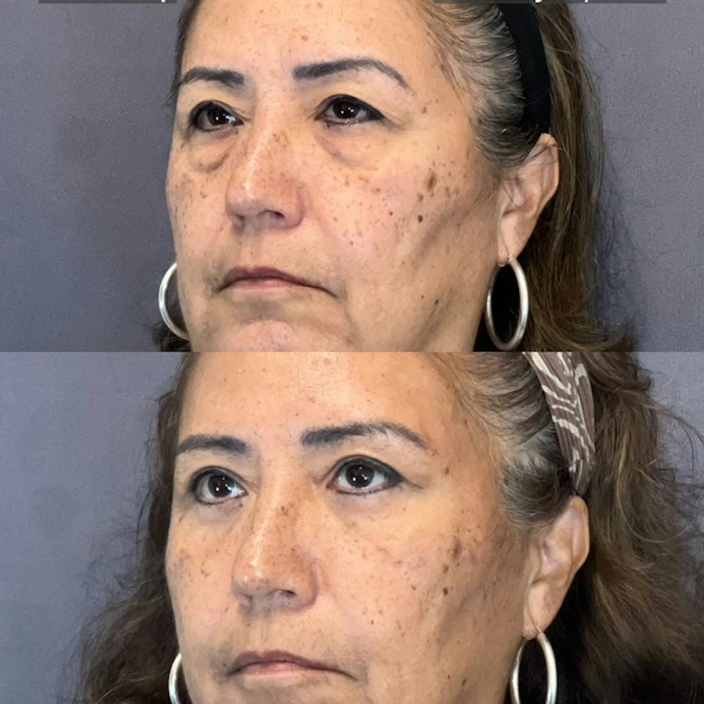 Lower Blepharoplasty Before & After Gallery - Patient 835184 - Image 3