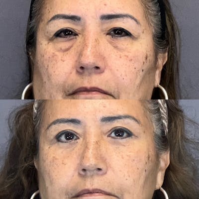 Lower Blepharoplasty Before & After Gallery - Patient 835184 - Image 1