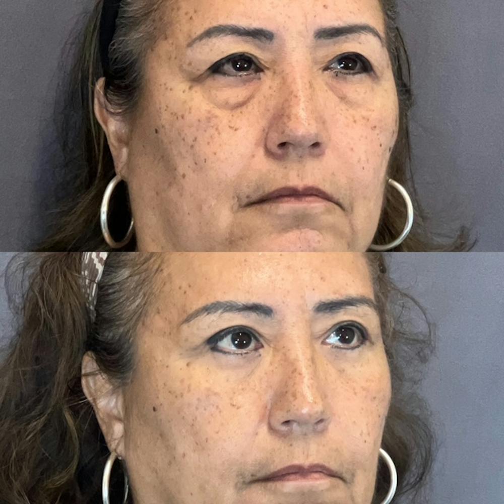 Lower Blepharoplasty Before & After Gallery - Patient 835184 - Image 4