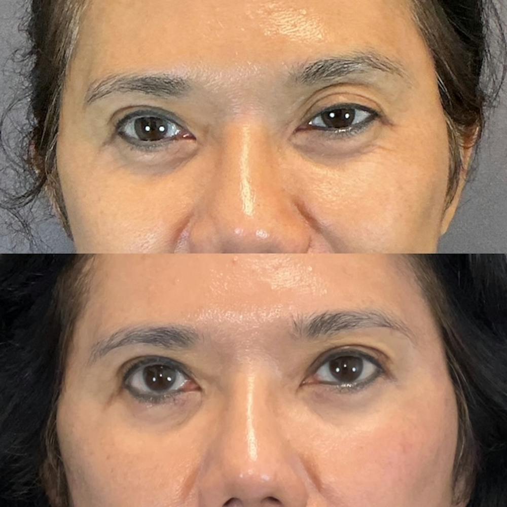 Ptosis Before & After Gallery - Patient 394052 - Image 1