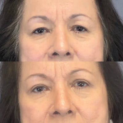 Upper Blepharoplasty Before & After Gallery - Patient 215083 - Image 1