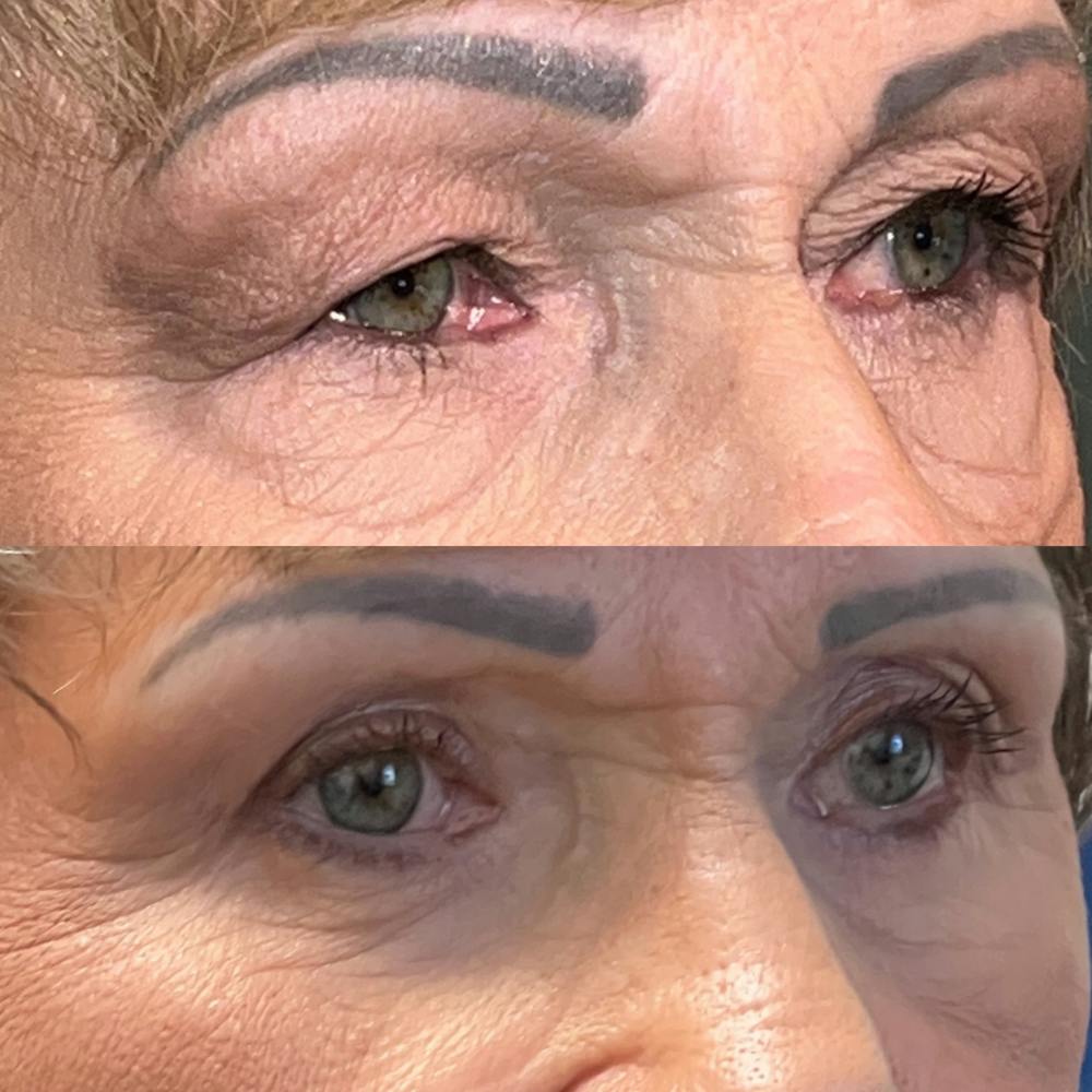 Lower Blepharoplasty Before & After Gallery - Patient 418357 - Image 3