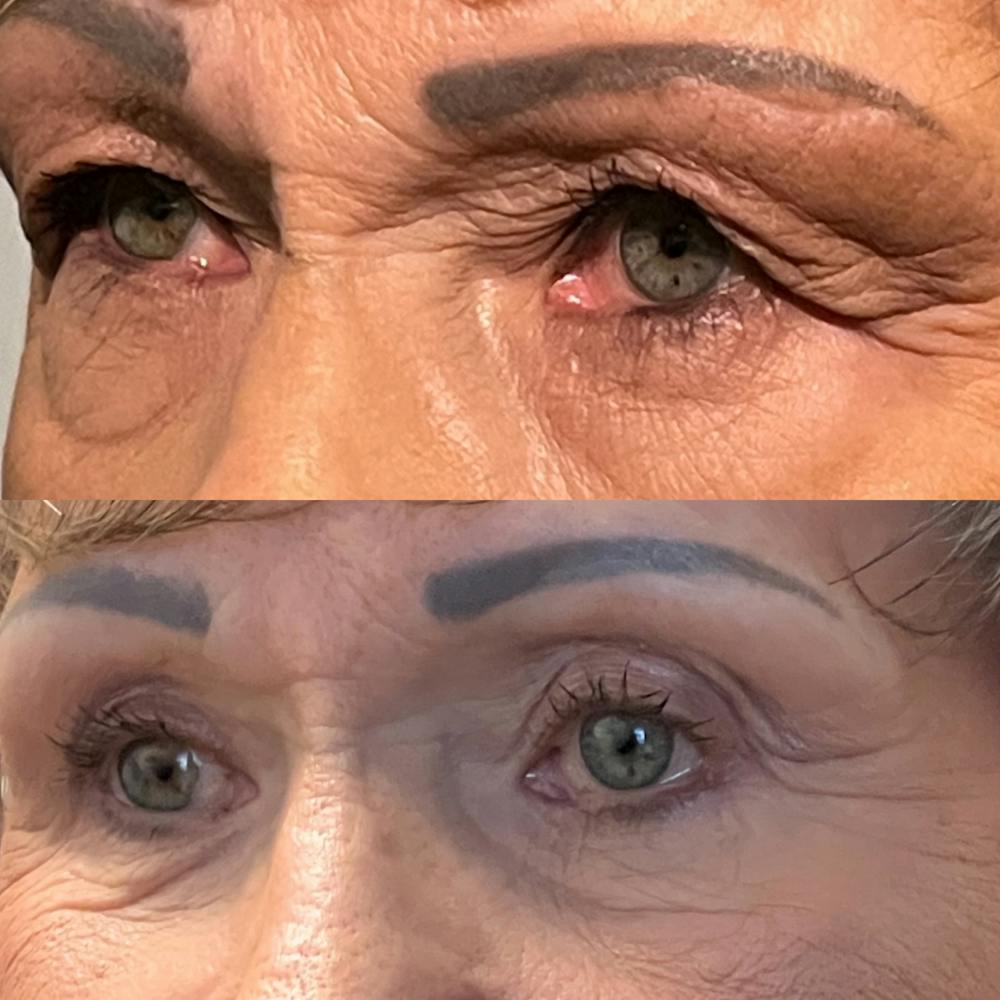 Lower Blepharoplasty Before & After Gallery - Patient 418357 - Image 2