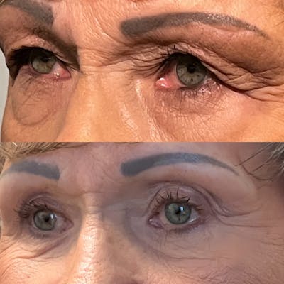 Lower Blepharoplasty Before & After Gallery - Patient 418357 - Image 2