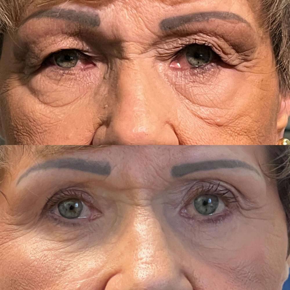 Lower Blepharoplasty Before & After Gallery - Patient 418357 - Image 1