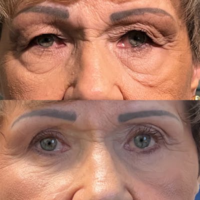 Lower Blepharoplasty Before & After Gallery - Patient 418357 - Image 1